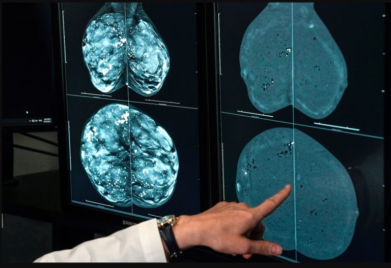 Cancer cases worldwide are expected to soar in the coming decades, a report finds. Here’s why. – The Washington Post